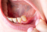 Snap-On Veneers for Missing Back Teeth | Instasmile