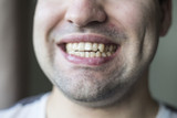 Crooked Teeth