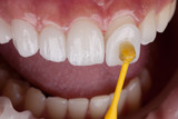 What aftercare support is needed for dental veneers?