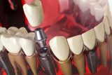 How many dental implants can you get?