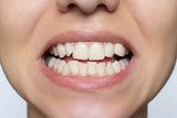 How to straighten teeth without braces
