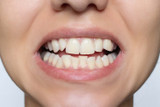 How to straighten teeth without braces