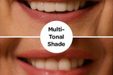 Clip-On veneers vs Porcelain Veneers 