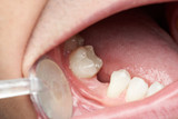 Can you get dental clips for missing teeth?