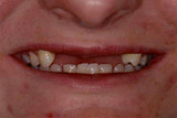 Common causes of teeth loss