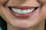 Natural looking snap on veneers