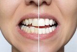 Snap-on Veneers vs. Permanent Veneers  Snap-on Veneers vs. Permanent Veneers
