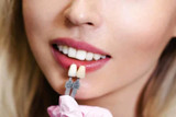 Teeth whitening vs Snap-On veneers