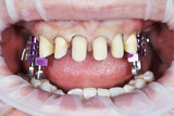 What happens to your teeth underneath veneers?