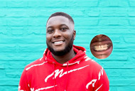 Benefits of snap-on veneers