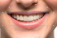 Cosmetic dentistry with gum disease