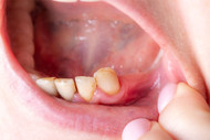Snap-On Veneers for Missing Back Teeth | Instasmile