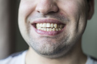 Crooked Teeth