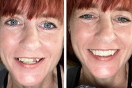 Gum contouring to improve smile