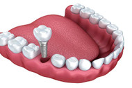 How long do dental implants hurt?