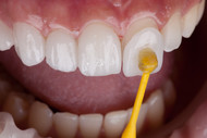 What aftercare support is needed for dental veneers?