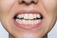 How to straighten teeth without braces