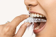 Invisalign vs Smile Direct Club - us.instasmile.com