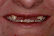 Common causes of teeth loss
