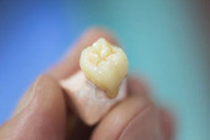 Temporary vs Permanent Dentures
