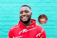 Porcelain veneers vs crowns