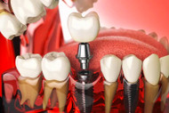 Cost of dental implants in the US