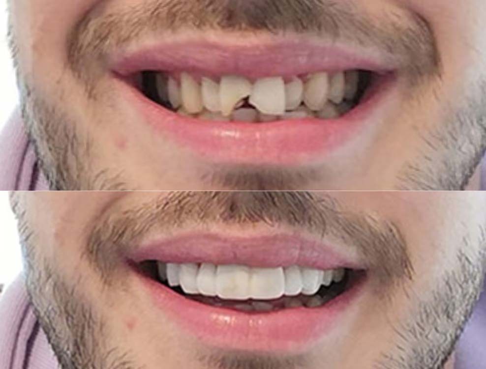3D CAD design of persons top teeth with chip on front tooth