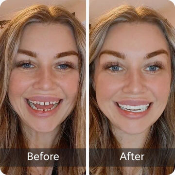 teeth with chip on front tooth