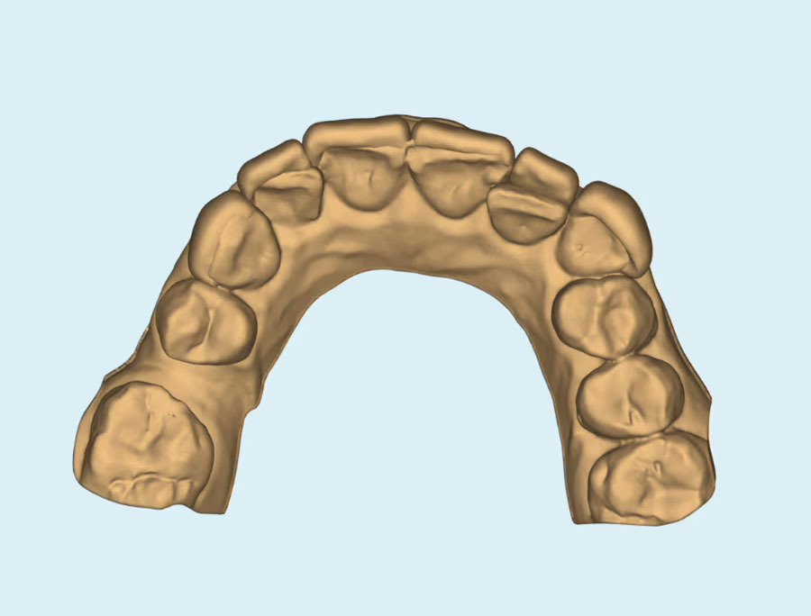 3D CAD design of persons top teeth with chip on front tooth