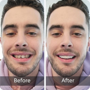 teeth with chip on front tooth