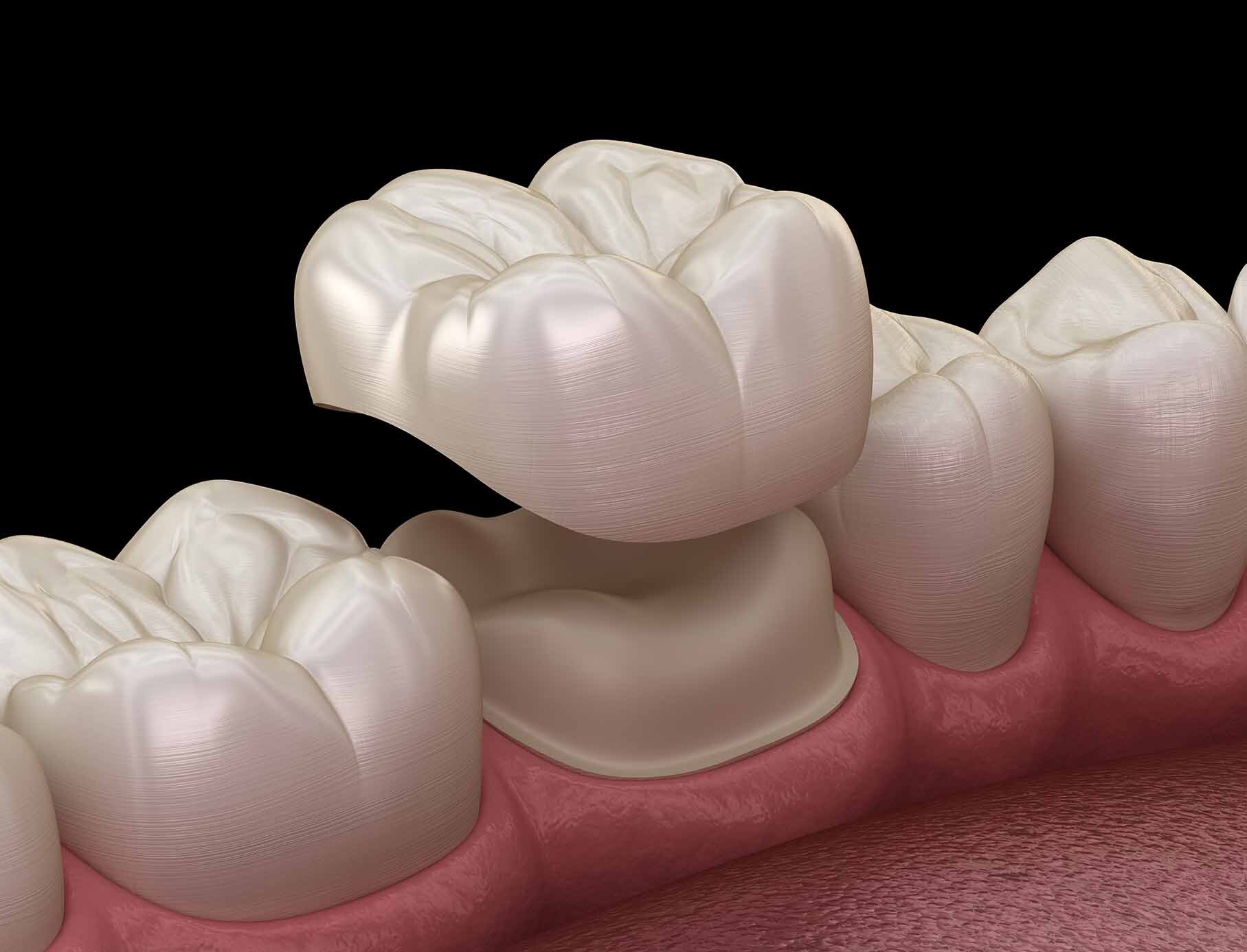 Cheap dental crowns - instasmile