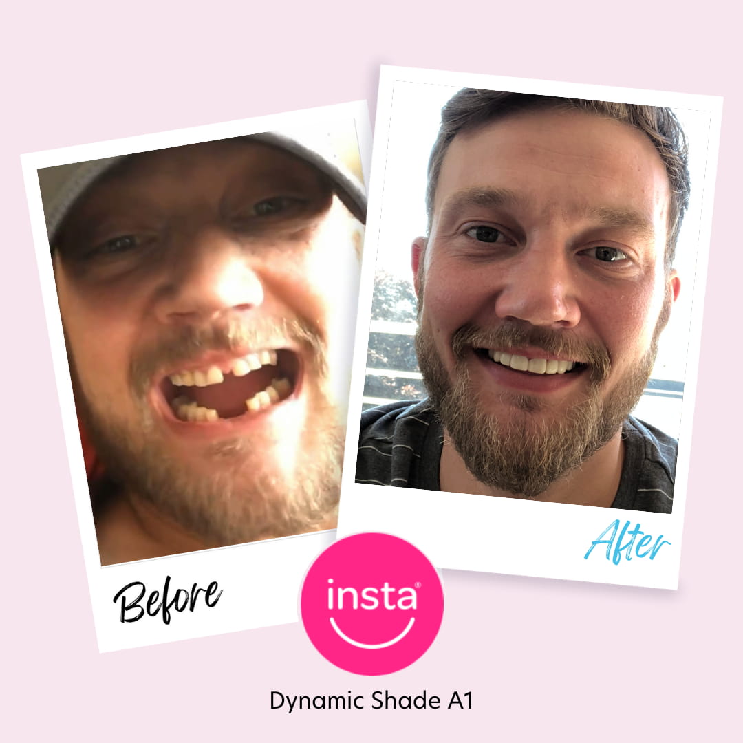 instasmile dynamic veneers