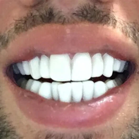 Fake teeth