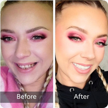 teeth with chip on front tooth