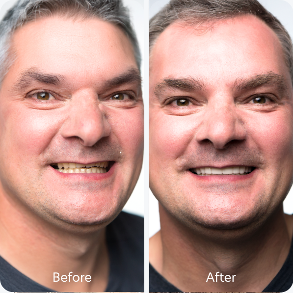 Worn Down Or Short Teeth teeth