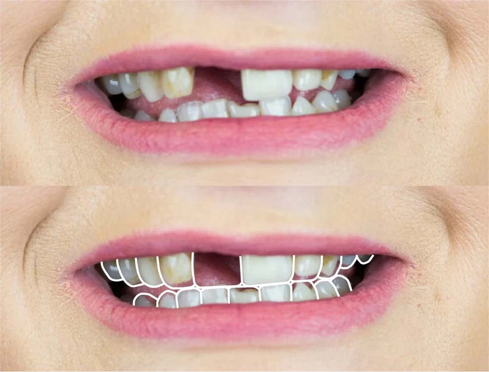 3D CAD design of persons top teeth with chip on front tooth