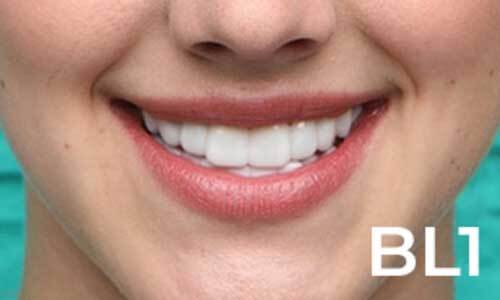 Reorder Instasmile Clip On Veneers