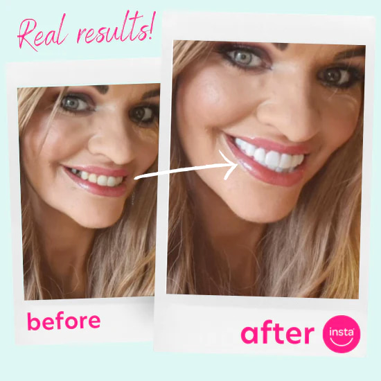 A woman before and after real results using Instasmile clip-on veneers