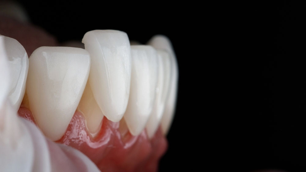 porcelain veneers for missing teeth  - instasmile