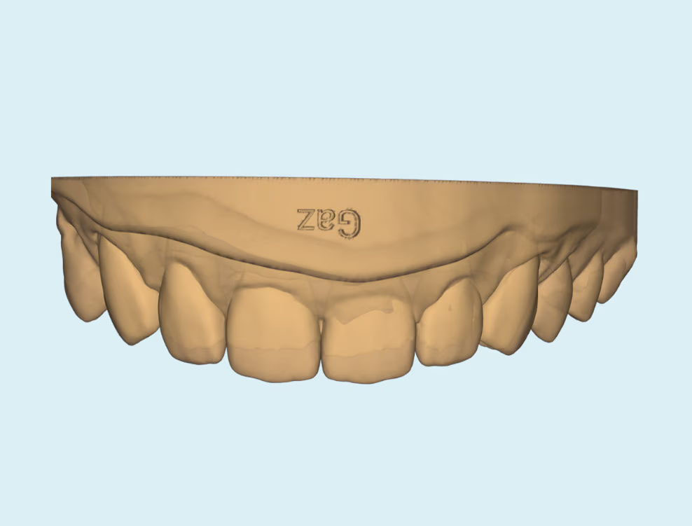 3D CAD design of persons top teeth with chip on front tooth