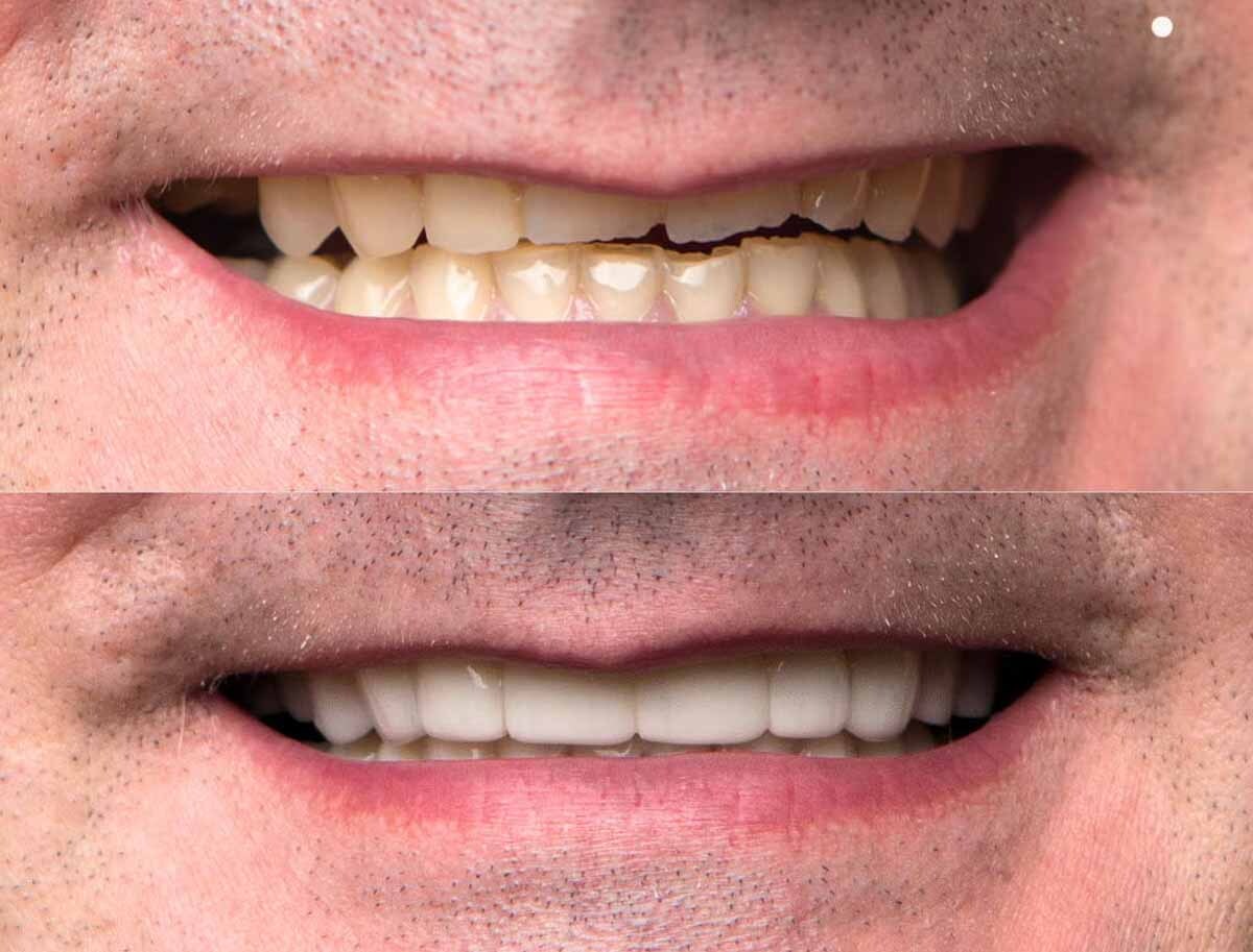 3D CAD design of persons top teeth with chip on front tooth