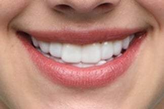 Instant Smile Teeth 8 pack THERMAL FITTING BEADS Cosmetic Dental Makeover -  Oral Care, Facebook Marketplace