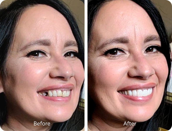 Man in opened blue button down shirt smiling with Instasmile veneers