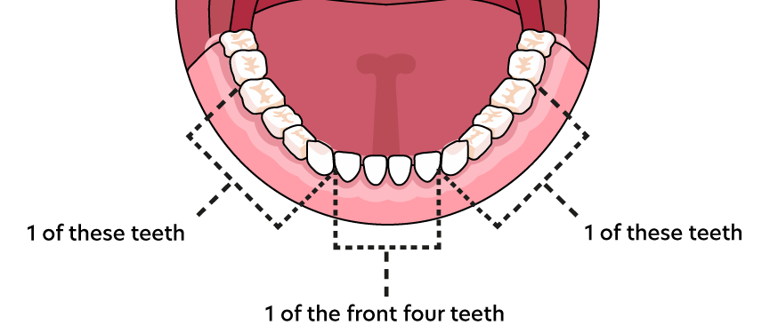 Bottom Teeth Suitability Chart