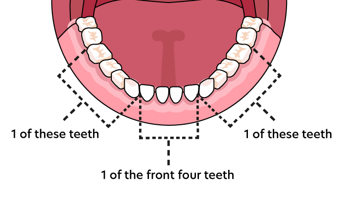 Bottom Teeth Suitability Chart