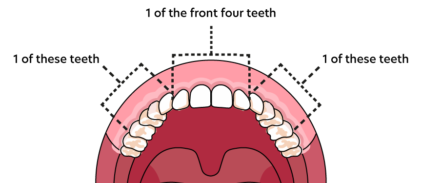 Top Teeth Suitability Chart