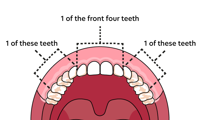 Top Teeth Suitability Chart