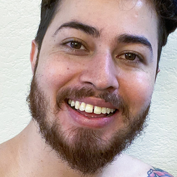 Before photo of chipped teeth before INSTAsmile smile makeover