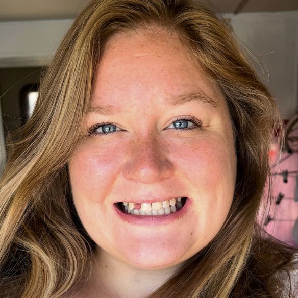 Before photo showing Farras smile before INSTAsmile treatment