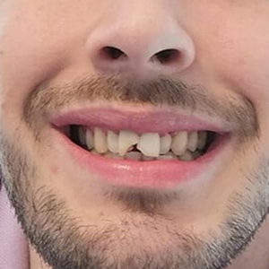 Design Chipped Teeth